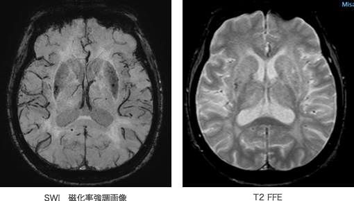 画像例（頭部領域 SWIによる微小出血の検索、梗塞or出血の鑑別）